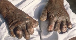 leprosy
