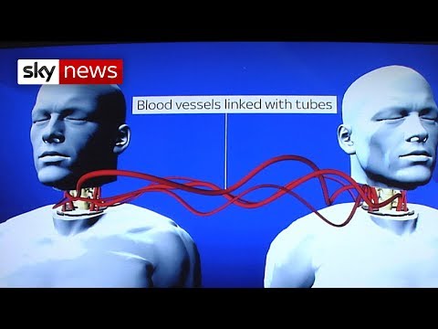 World&#039;s First Head Transplant: What&#039;s Involved?