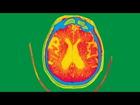 Could smell test detect Alzheimer&#039;s disease?