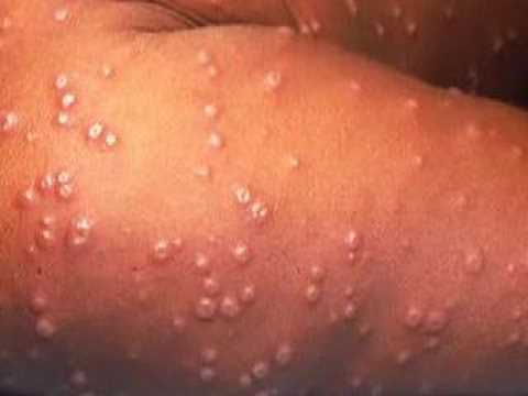 Top 10 Worst Diseases - 91