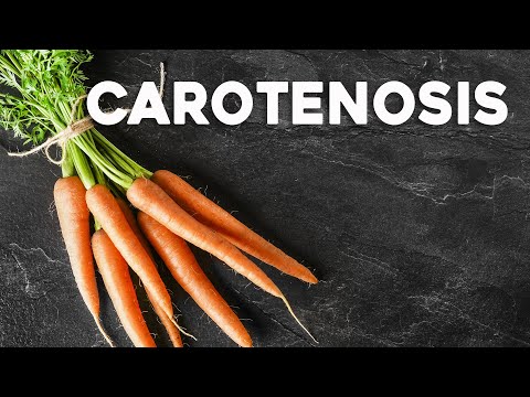 How Too Many Carrots Can Turn Your Skin Orange - Carotenosis | Corporis