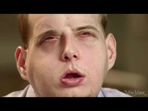 Man Gets Full Facial Transplant
