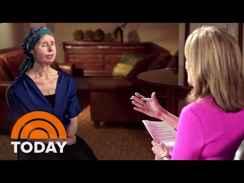 Chimp Attack Survivor Charla Nash Opens Up About Face Transplant Setback | TODAY