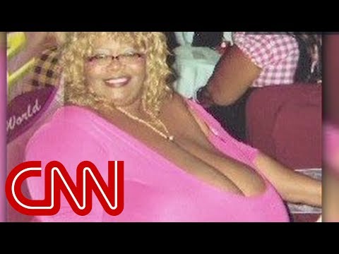 Woman&#039;s breasts weigh 89 pounds