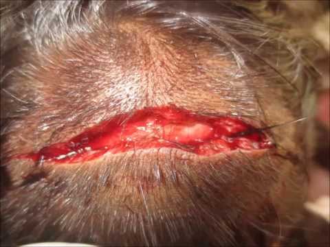 Severe Dog Bite &amp; Abscess Drained