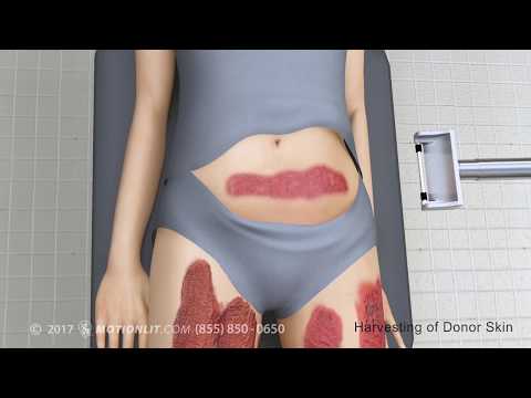 Skin Graft Procedure Animation