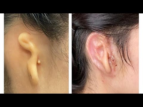 Watch: Scientists 3D print ear from human cells and transplant into patient in medical breakthrough