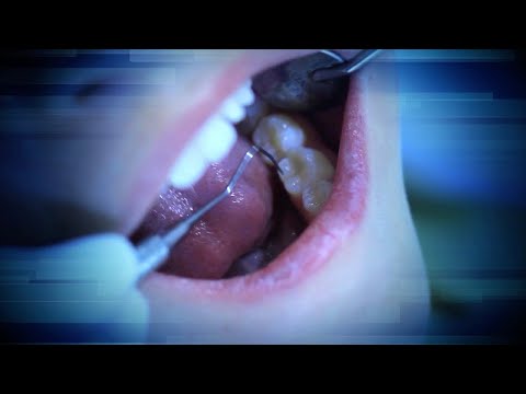 Can Getting a Root Canals Have Dangerous Side Effects?