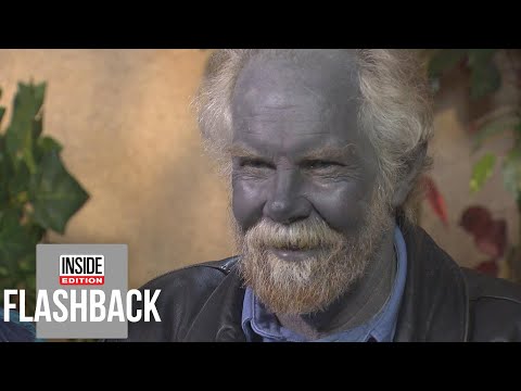 Why This Man’s Skin Turned Blue