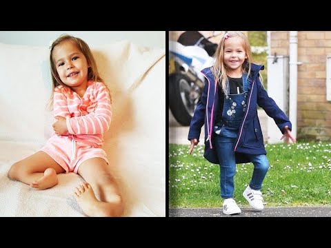 3-Year-Old Girl Born With Legs Bent Backward Is Now Walking