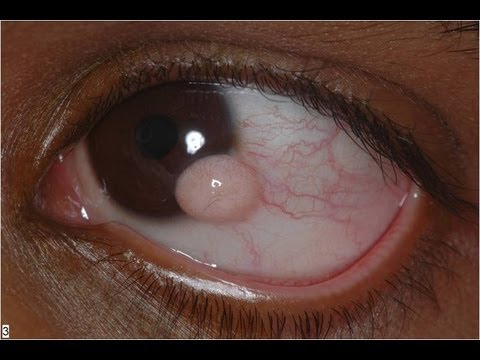 Limbal Dermoid excision