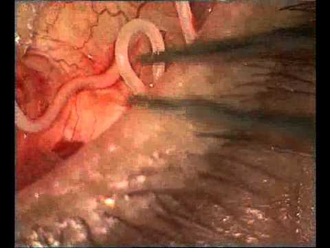 13cm live worm removed from eye at fortis hospital.avi