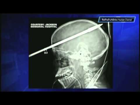 (( A MIRACLE )) He survives a spear in brain ! Miami June 2012