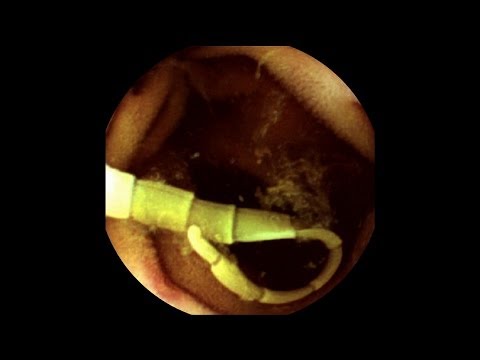 An investigation of Michael Mosley&#039;s tapeworms - Infested! Living with Parasites - BBC