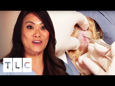 Dr. Pimple Popper | Removing Five 35 Year Old Cysts!