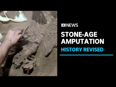 Earliest-known surgical limb amputation found in stone-age skeleton | ABC News