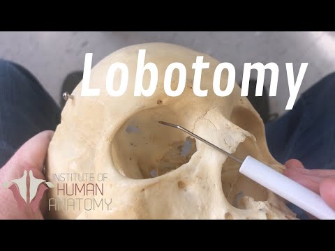 The Anatomy of a Lobotomy