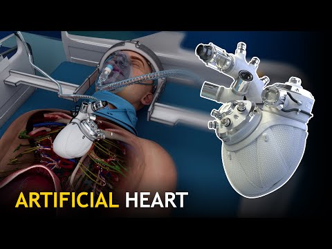 Fully Implantable Artificial Heart