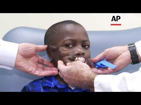 Boy Mauled By Chimps to Undergo Facial Surgery