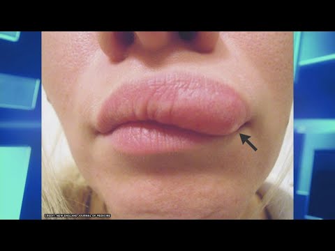 6-Inch Roundworm Found in Woman’s Lip!