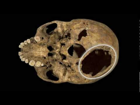 Richard III - Injuries to the Remains