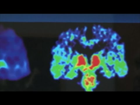 New concussion evaluation technology driven by former Cal Poly football player