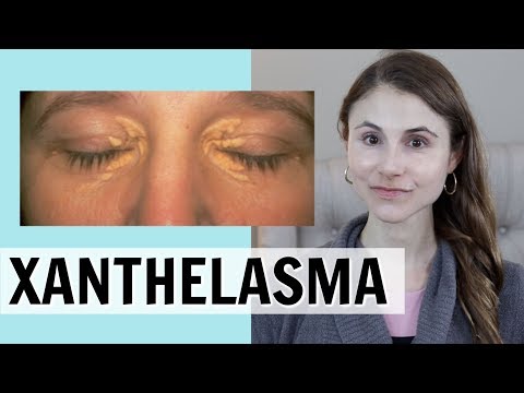 XANTHELASMA: WHAT IT IS &amp; HOW IT IS TREATED| DR DRAY