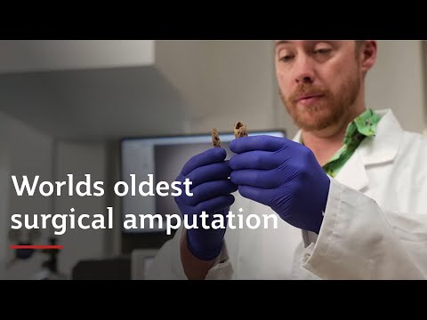 Griffith University Archaeologists discover worlds oldest surgical amputation