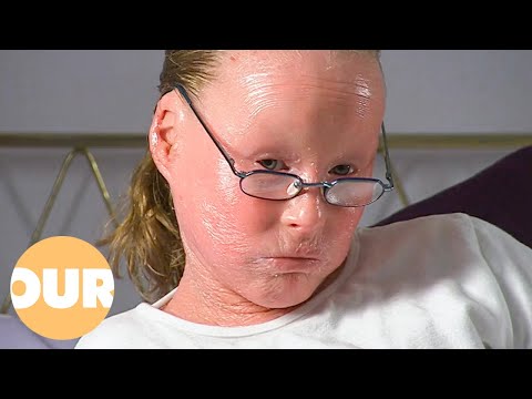 Living With An Incredibly Rare Skin Condition (Harlequin Ichthyosis) | Our Life
