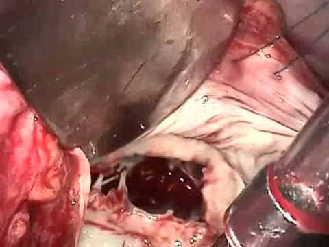 Mitral Valve Replacement for Rheumatic Heart Disease