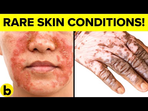 9 DESTRUCTIVE Skin DISEASES And Why You WILL Get Them