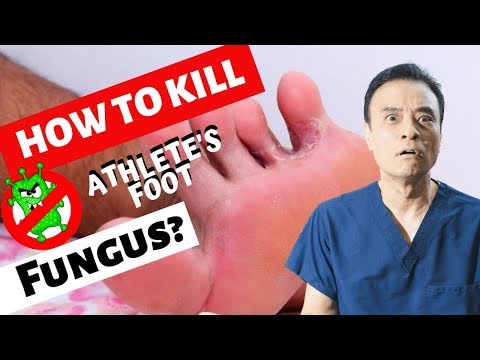 How to kill athlete&#039;s foot fungus?