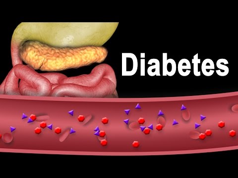 Diabetes Type 1 and Type 2, Animation.