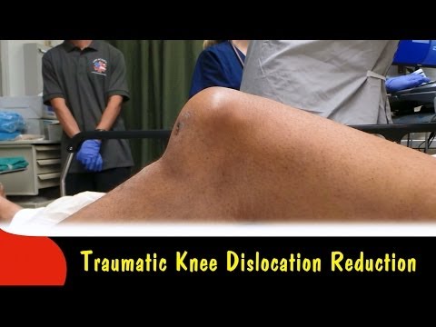 Traumatic Knee Dislocation Reduction-Quick Version