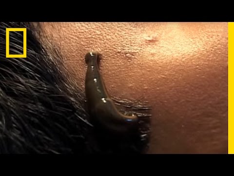 Leeches Cure | National Geographic