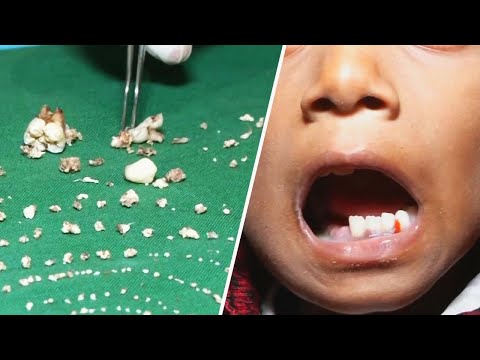 Doctors Remove Over 500 Teeth From Boy&#039;s Mouth