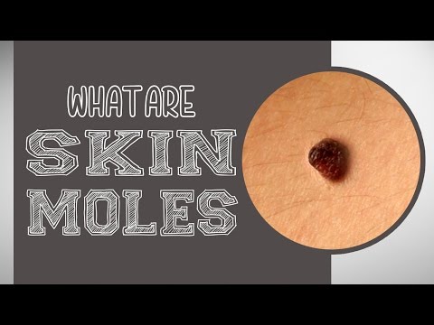 What are Skin Moles?