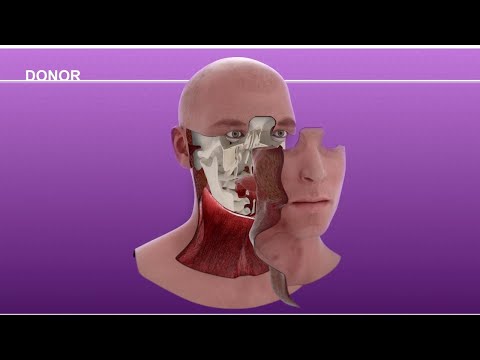 Cameron Underwood Face Transplant Surgical Animation 2018