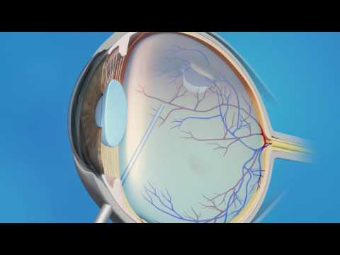 Detached Retina: Vitrectomy