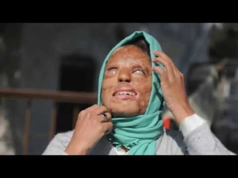 Acid Attacks add to Violence against women in Kashmir