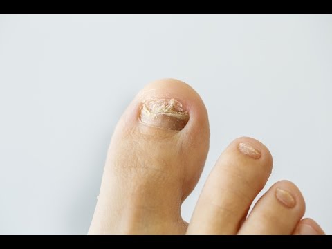 How to prevent and treat nail fungus