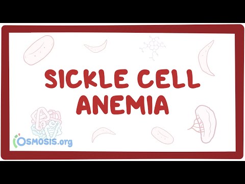 Sickle cell anemia - causes, symptoms, diagnosis, treatment &amp; pathology