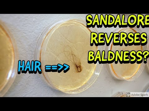 SANDALORE REVERSES HAIR LOSS?!?!