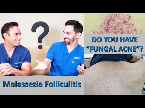 Fungal acne (Malassezia folliculitis) versus Comedonal acne