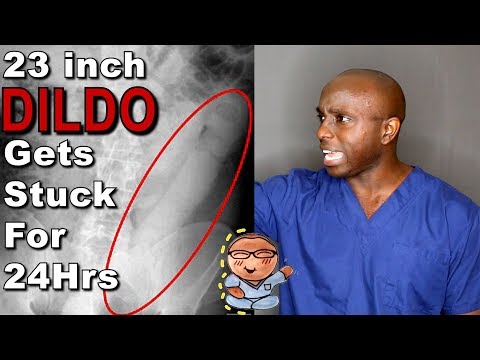 23 inch Dildo Lodged Inside A Man | Nursing News