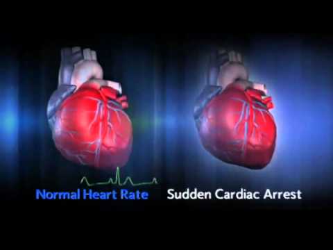 Sudden Cardiac Arrest (SCA)