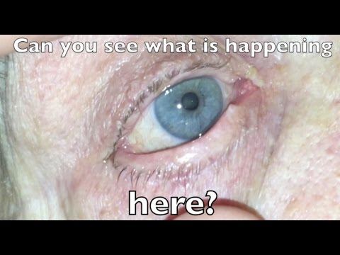 10 Strange Things That Can Happen To Your Eyes - 70