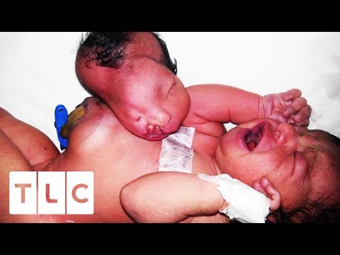 Baby Born With Two Heads Gets Vital Surgery | Body Bizarre