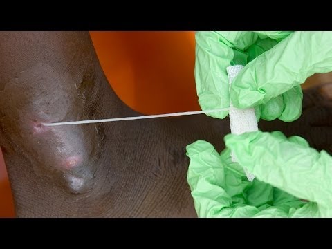 Top 10 Most Horrific Parasite Infections - 37