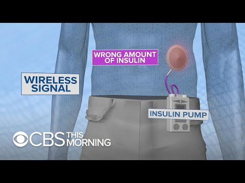 How medical devices like pacemakers, insulin pumps can be hacked